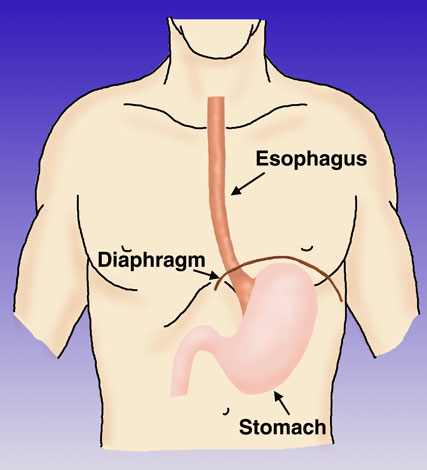 Tumore dell'esofago